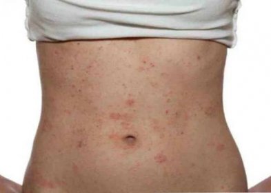 Pet Alergie Příznaky a léčba / Alergie na kůži a sliznice | Užitečné informace a tipy na péči o sebe. Zdraví, výživa a další