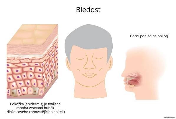 Bledost - příznaky a léčba