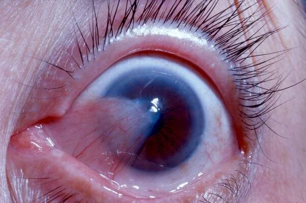 This pterygium is encroaching on the visual axis of the eye affecting vision.