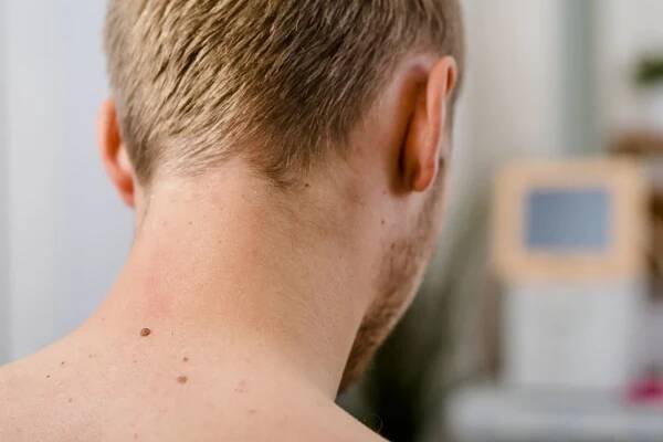 Odstranění nežádoucích znamének, pih či bradavic frakčním laserem
