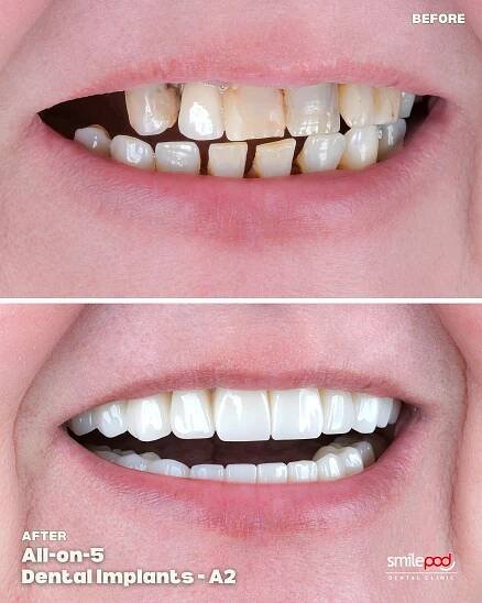 all-on-five-dental-implants-turkey-before-and-after-02