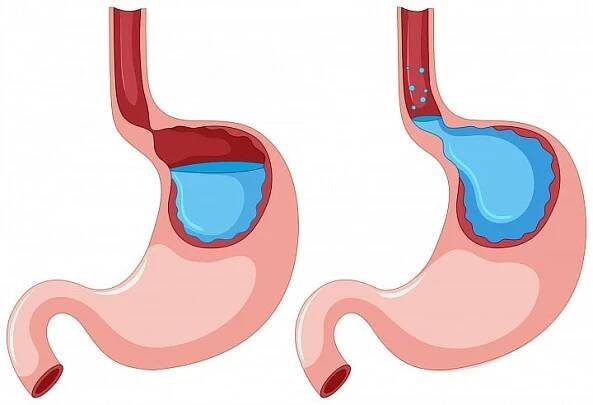 Laryngofaryngeální reflux: Tak trochu jiné pálení žáhy, které není radno podceňovat, důrazně varuje lékařka!