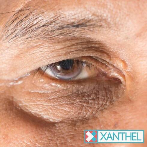 malá xanthelasma 3