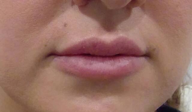 Before & After Gallery | Re:nu 180 Medspa