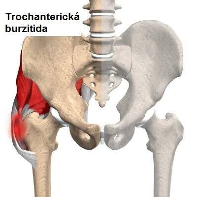 Burzitida, zánět kloubní burzy - příznaky, projevy, symptomy - Příznaky a projevy nemocí
