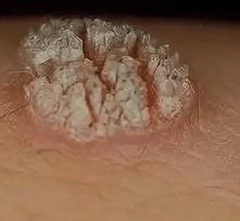 Papilomy (HPV)