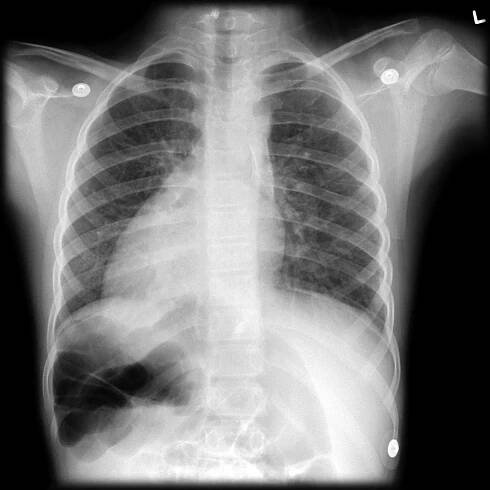 (ZAČÁTEČNÍCI) Prohozené svody na EKG - Kardioblog