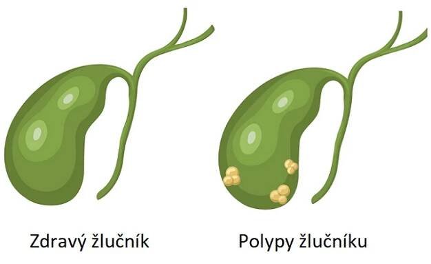 Polypy na žlučníku - ilustrace