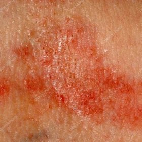 Alergická vyrážka dermatitida kůže