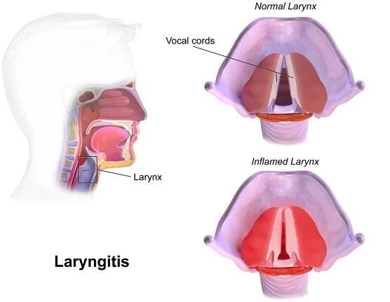 Akutní laryngitida – WikiSkripta