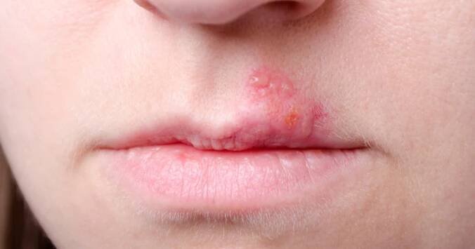 Herpes zmizí beze stopy. Jeho vymítačem je například jedlá soda i jablečný ocet