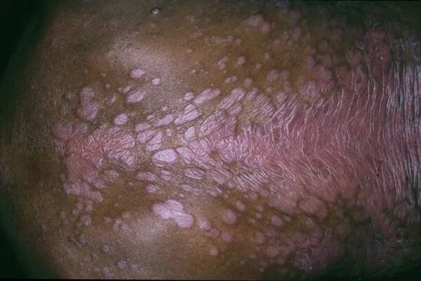 Plaque psoriasis. Image courtesy of Hon Pak, MD.
