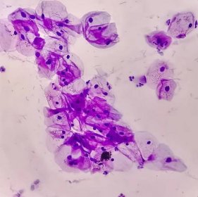pohled v mikroskopických lidských buňkách děložního čípku. dlaždicové epiteliální buňky. pap nátěr. pap' s. diagnóza rakoviny děložního čípku - skvamocelulární karcinom - stock snímky, obrázky a fotky