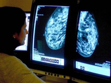 Alternativní metoda slibuje, že pozná nádor prsu podle barvy. Lékaři jsou z ní zděšeni