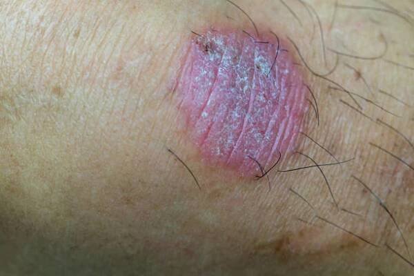 infekce kruhového červa, dermatofytóza na kůži. kožní infekce nebo tinea na kůži. infekce mykózy na lidské kůži. je způsobena houbou - erysipel vyrážka - stock snímky, obrázky a fotky