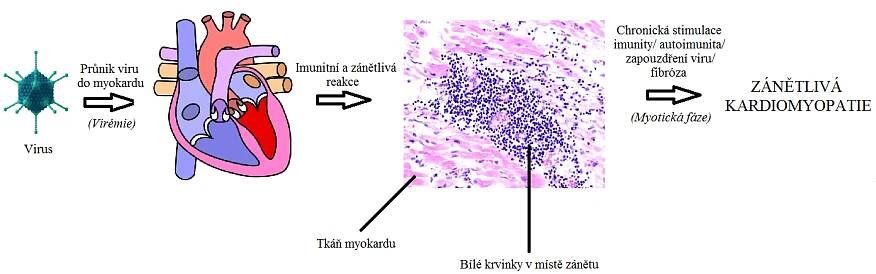 Schéma myokarditida