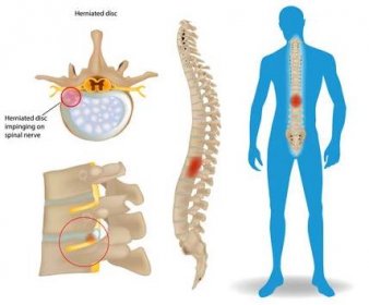 Spinal Disc Herniation. Back Pain Human. Spinal Cord Compression. Bulging disc.