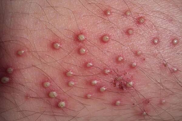 31 Facts About Folliculitis