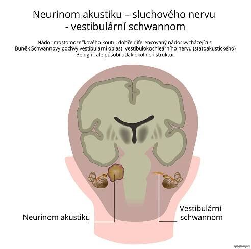 Vestibulární schwannom - příznaky a léčba