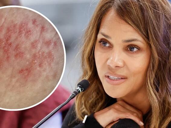 Does the menopause cause herpes outbreaks?