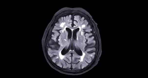 MRI mozku nebo magnetická rezonance mozku pro diagnostiku mozkových nádorů a cévní mozkové příhody. — Stock záběr