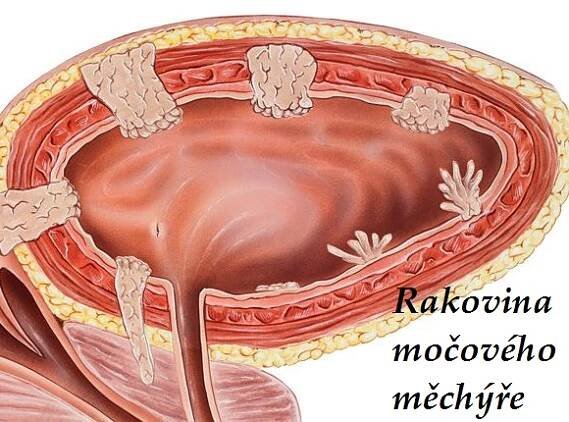 rakovina-mocoveho-mechyre-priznaky-projevy-symptomy