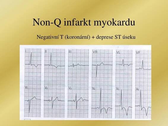 PPT - EKG – úsek ST, vlny T a U PowerPoint Presentation, free download - ID:4877145