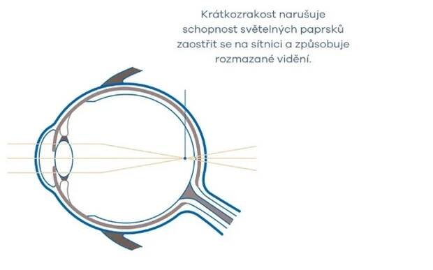 Dětské brýlové čočky pro zpomalení růstu krátkozrakosti. Easy Optic. Easy Optic