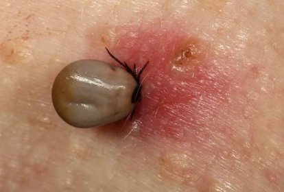 A tick on a person's skin