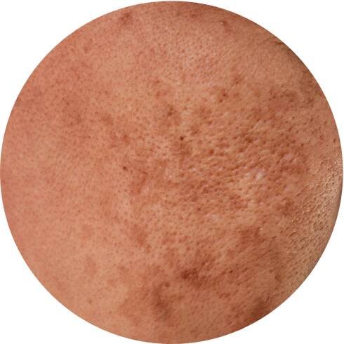 Melasma