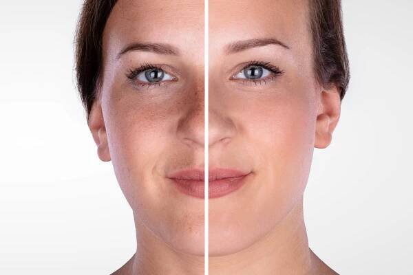 Microdermabrasion Results: Benefits, How to Maintain Them, Before and Afters, and More