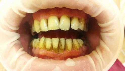V tomto stádiu je prevence i léčba nejúčinnější. Proto by každý při jakémkoliv příznaku měl ihned navštívit zubního lékaře.