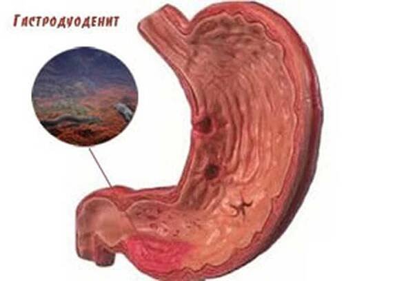 Příčiny a příznaky gastroduodenitidy / Gastroduodenitis