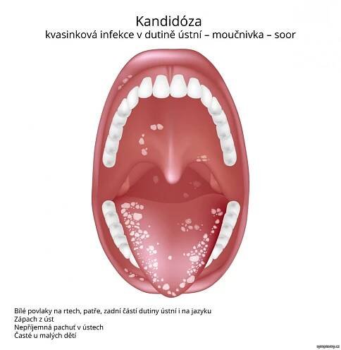 Kandidóza - příznaky a léčba