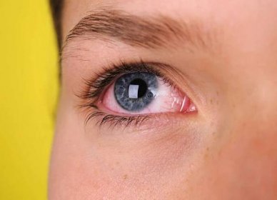 Červené oči: Přemíra alkoholu, nebo příznak nemoci?