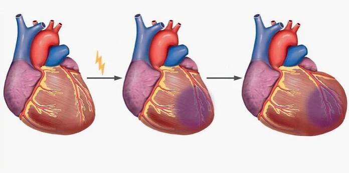 Infarkt myokardu vede k bolesti lopatek