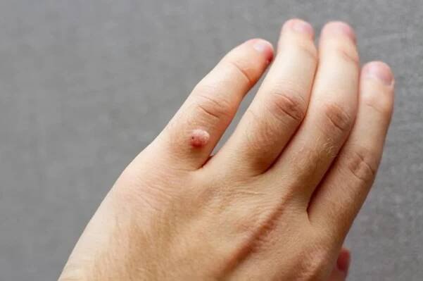 Jablečný ocet jako přírodní pomocník při odstraňování bradavic: Funguje opravdu?