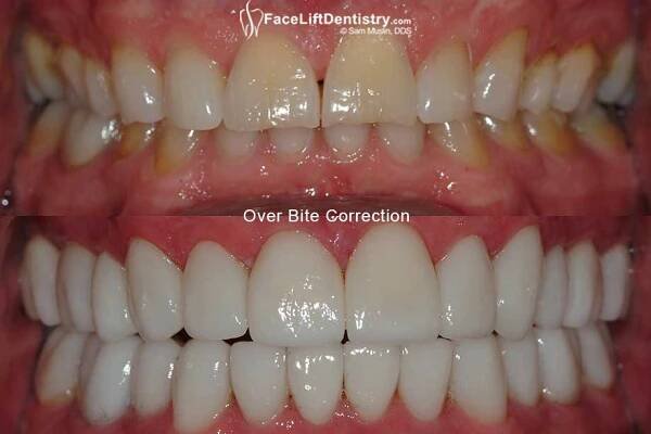 Deep over bite closeup photo, before and after