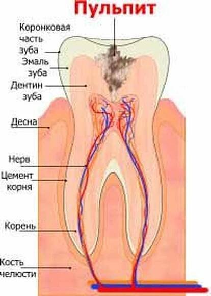 Pulpitis / Pulpitis