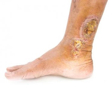 Venous leg ulcers: evidence review - Evidently Cochrane