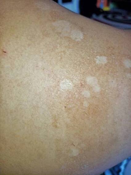 tinea versicolor pityriasis versicolor na kůži - pityriasis versicolor - stock snímky, obrázky a fotky
