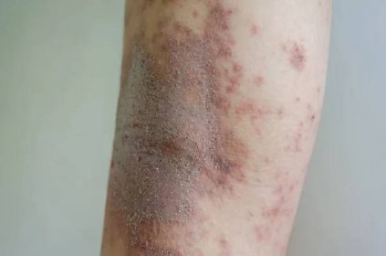 Červená vyrážka dívka Kožní onemocnění způsobené alergiemi na léky, jídlo, chemikálie, špatný imunitní systém v lymfatické. — Stock obrázek