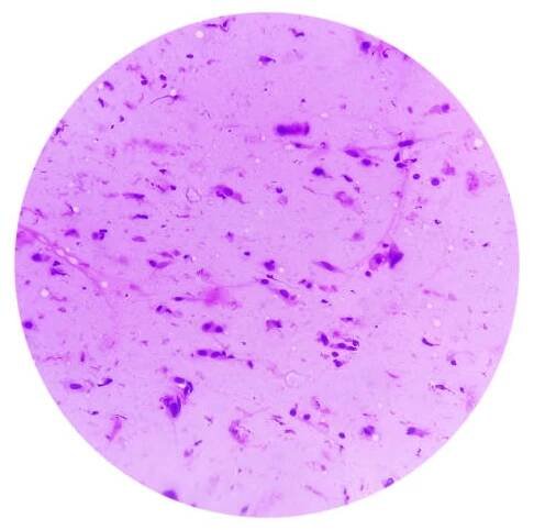 mikrosnímek ukazující neurofibrom. neurofibromatóza je genetická porucha, genové mutace. - neurofibromatóza - stock snímky, obrázky a fotky