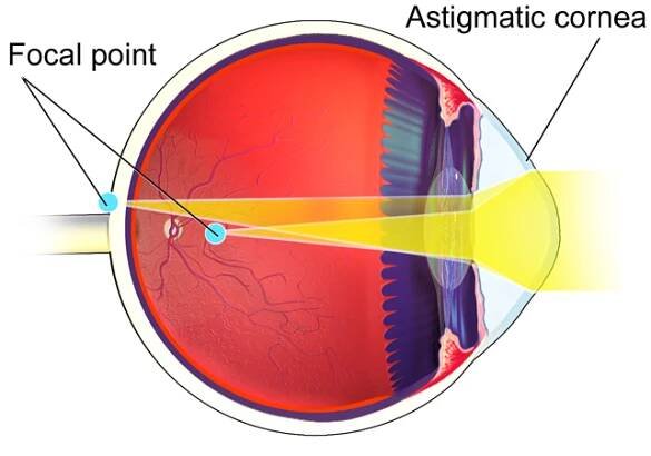 Astigmatismus
