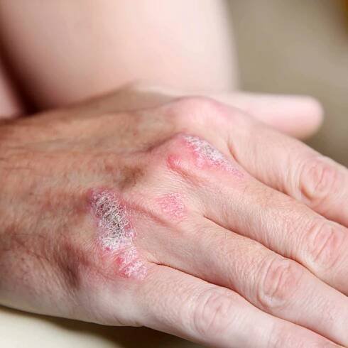 Prieskum: Viac ako polovica psoriatikov pociťuje spoločenské obmedzenia