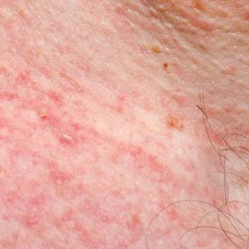 Keratóza nebo papilom na kůži dospělého. Dráždivost nebo alergická reakce. — Stock obrázek