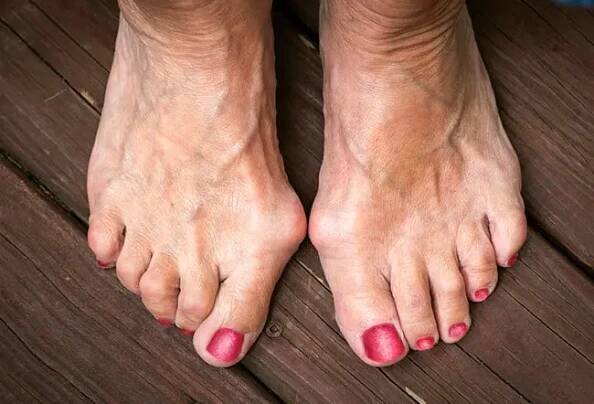 How Do You Cure a Bunion Naturally? 7 Natural Remedies