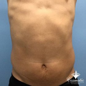 Emsculpt® Muscle Toning and Fat Reduction Treatments In McLean, VA