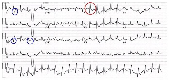 Akutní embolie - EKG | Medicína, nemoci, studium na 1. LF UK