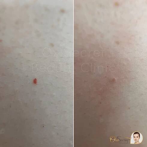 Odstranění kožních výrůstků: hemangiomů, fibrom či milií - Obrázek 9